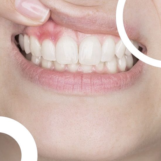 Traitement professionnel d'un abcès dentaire au Centre Dentaire Maarif avec des outils spécialisés, garantissant des soins de qualité pour soulager la douleur et prévenir les complications.