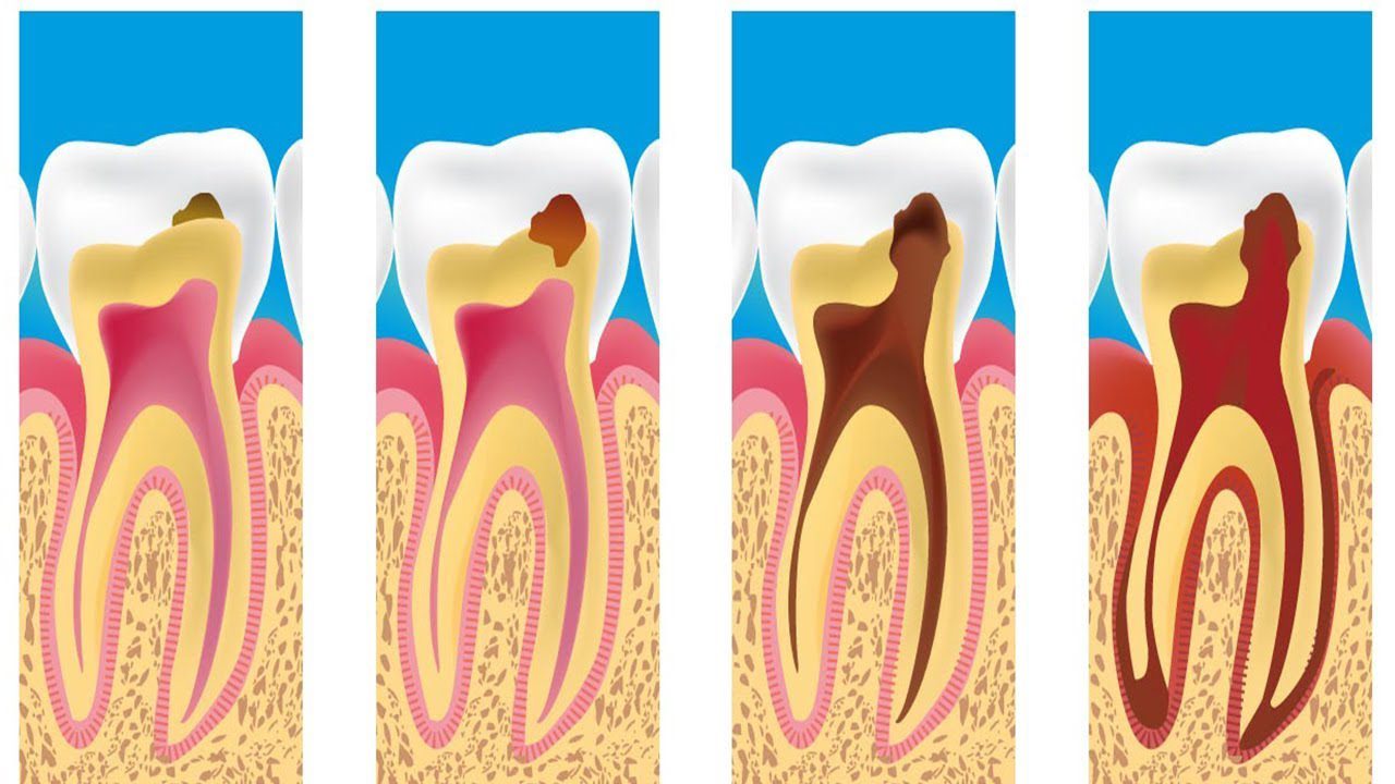 Comment les caries se développent-elles ? Dentaire à Casablanca