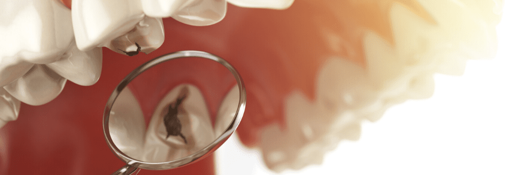 Que faire si j’ai une carie ? Conseils dentaire à Casablanca