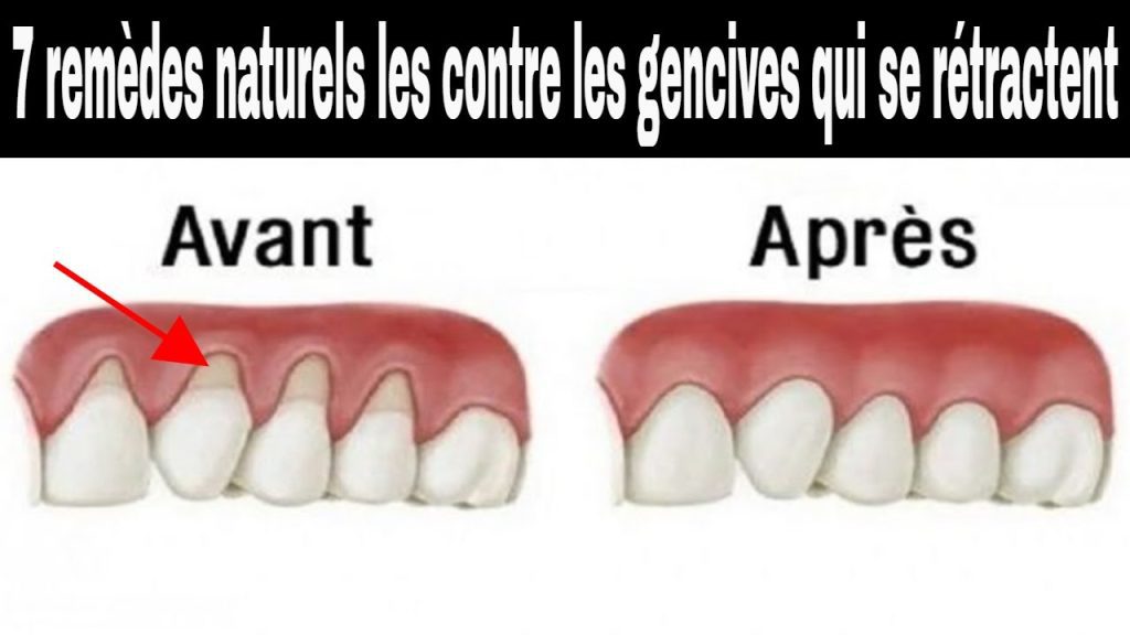 Saignement des gencives à Maarif Casablanca : Comment l'éviter ?