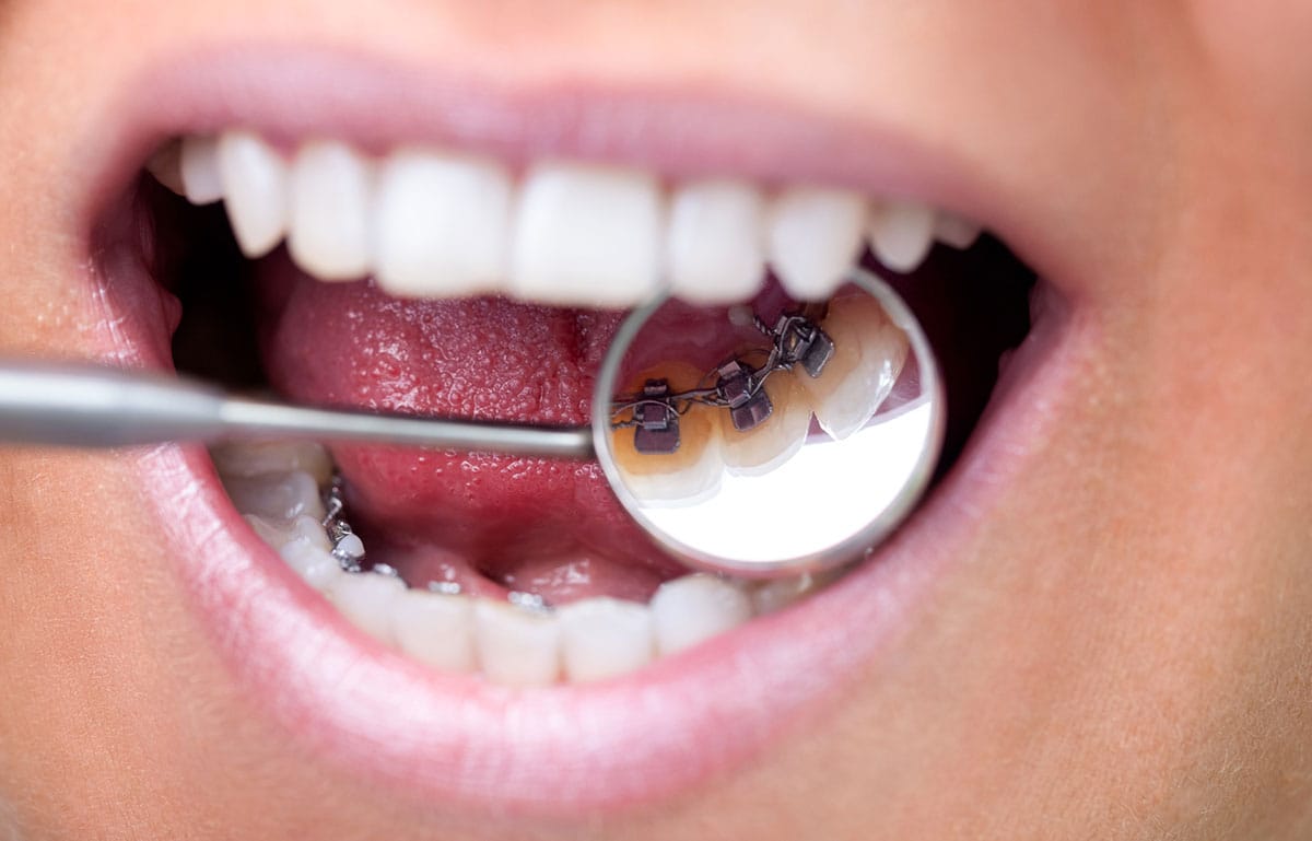 Appareils Orthodontiques Invisibles Dentiste Casablanca