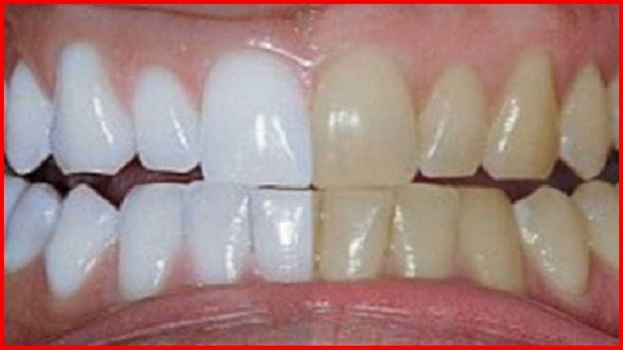 Blanchiment Dentiste Casablanca : efficacité et sécurité