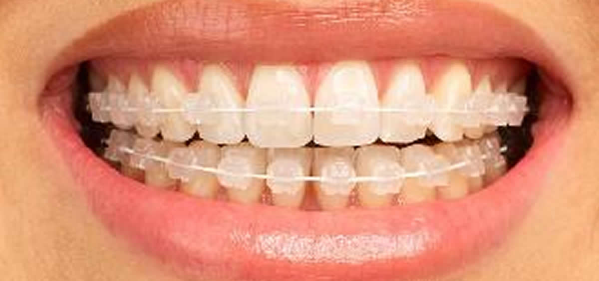 Dentiste Casablanca : Orthodontie Invisible avec Invisalign