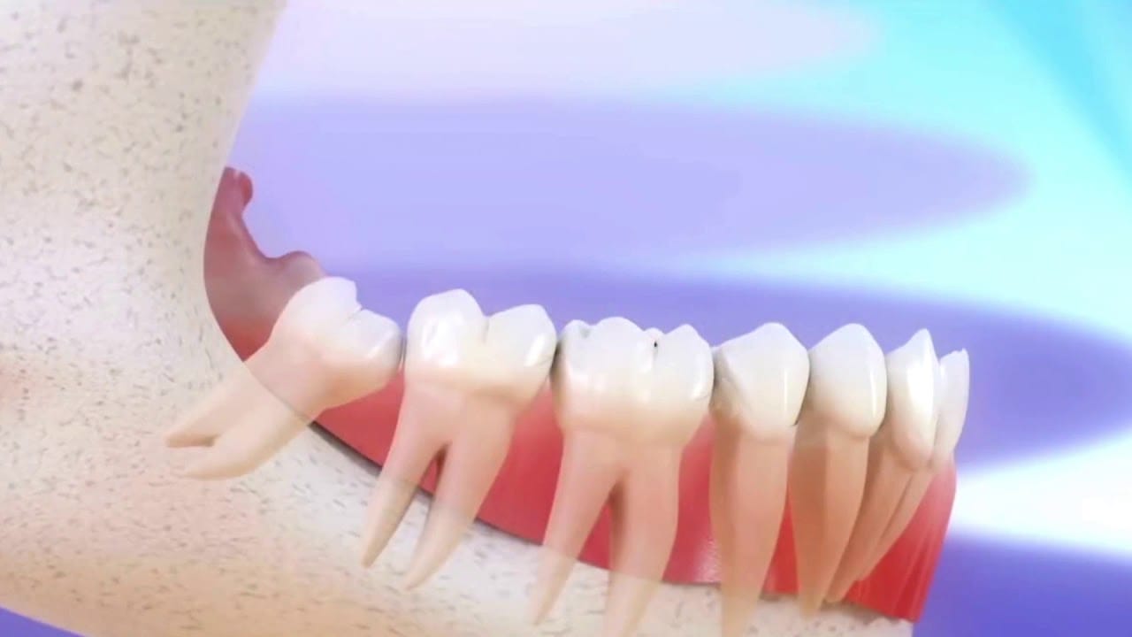 Dentiste Casablanca : Soins ,conseils pour vos dents de sagesse