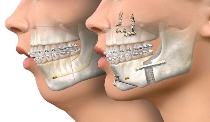 Dr Benchekroun Salma Dentiste Casablanca : Soins Orthodontiques