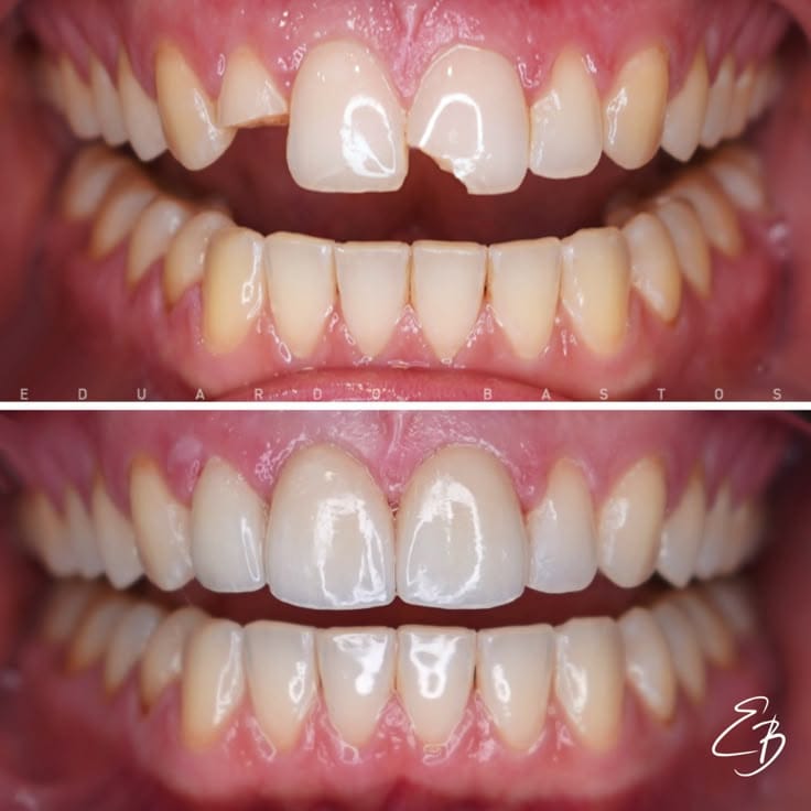 Dent cassée : consultez Dentiste Casablanca rapidement !