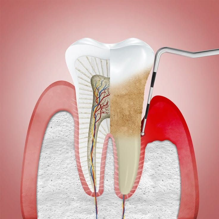 Parodontie : Soins Gencive Dentiste Casablanca