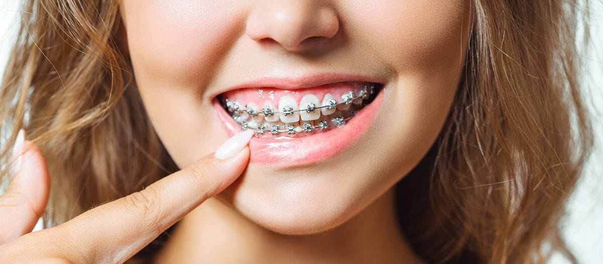 Les bagues dentaires : Dentiste Casablanca