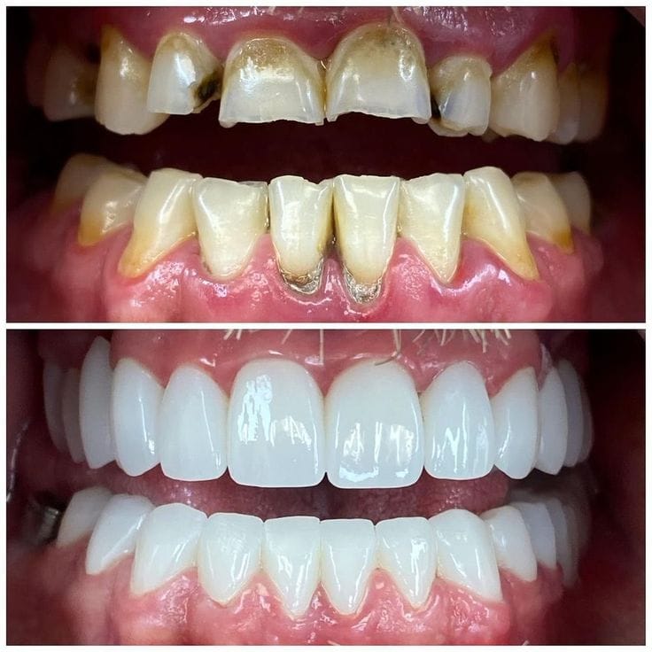 Réhabilitation du sourire : Une transformation spectaculaire