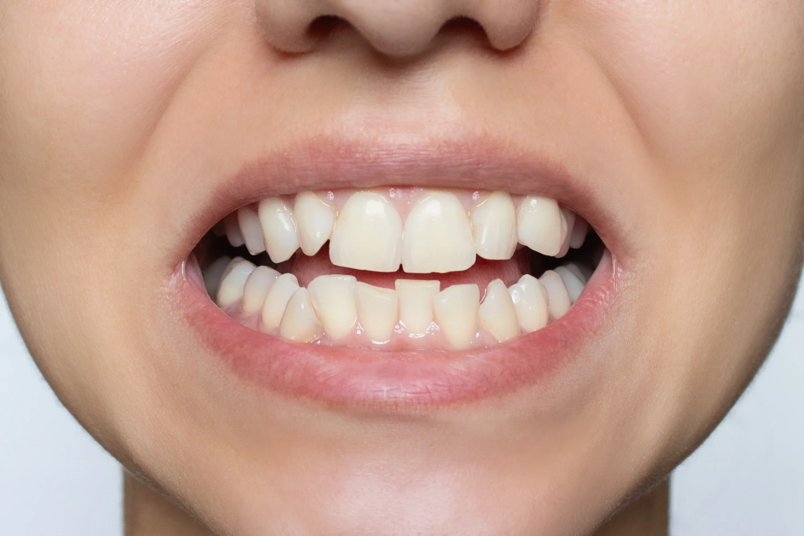 Dents qui poussent de travers ?  Vous vous demandez pourquoi ? Dr Salma Benchakroun – dentiste à Casablanca