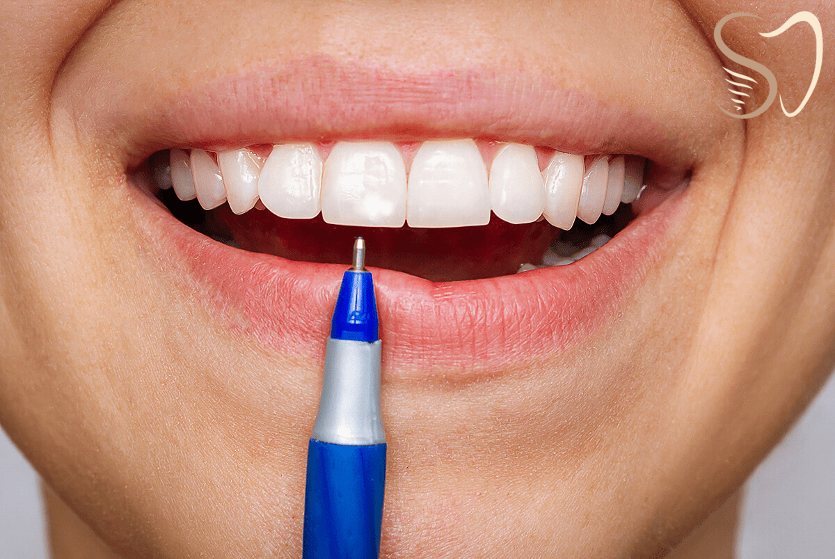 Taches blanches sur les dents : simple défaut esthétique ou vrai problème ?