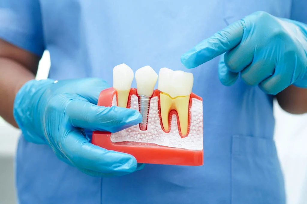 Les implants en zircone : l’alternative sans métal pour un sourire naturel et durable